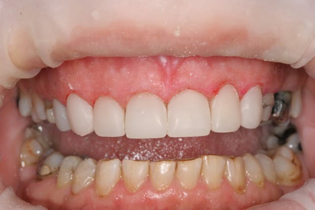 Box hill partial dentures