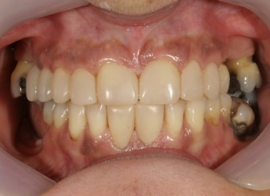 partial dentures Blackburn