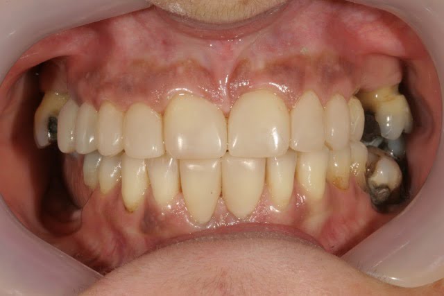 partial dentures Blackburn