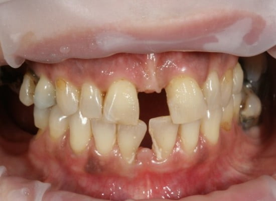 teeth implants Mitcham