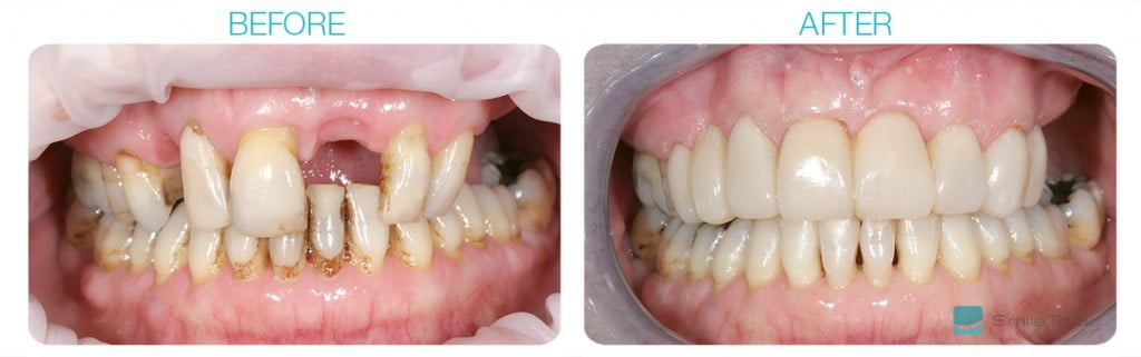 implant dentistry Surrey Hills