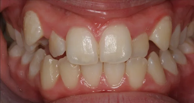 Crooked Teeth Dentist Forest Hill