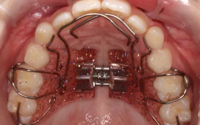 How To Avoid Future Extractions and Possibly Full Braces In Children