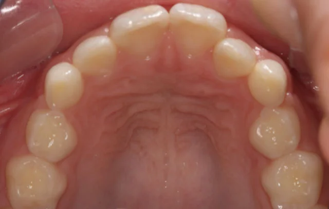 Dental Expansion Plate