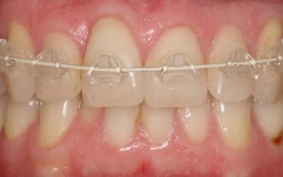 What benefits does Fastbraces have over Traditional braces?