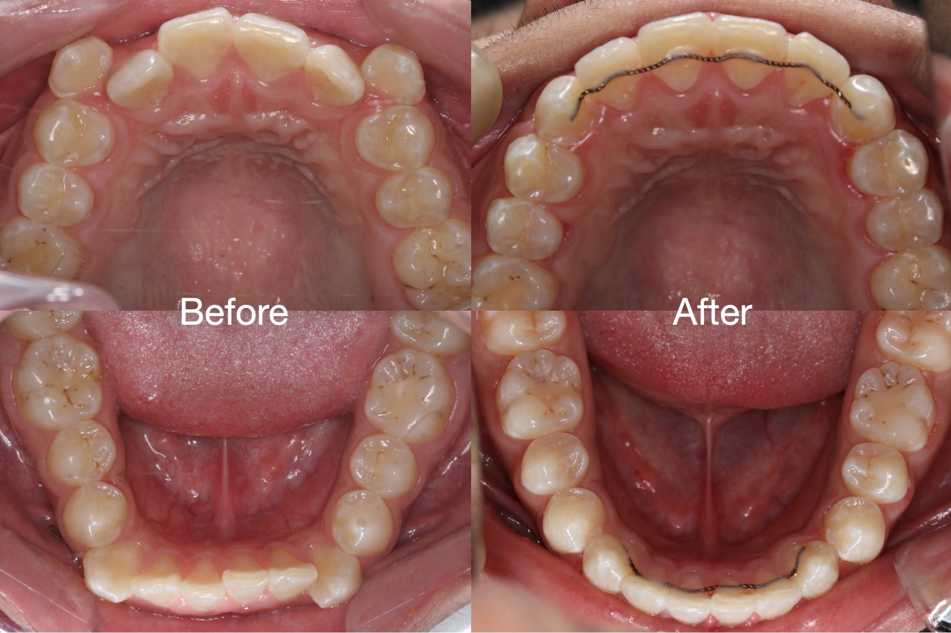 dentures Surrey Hills