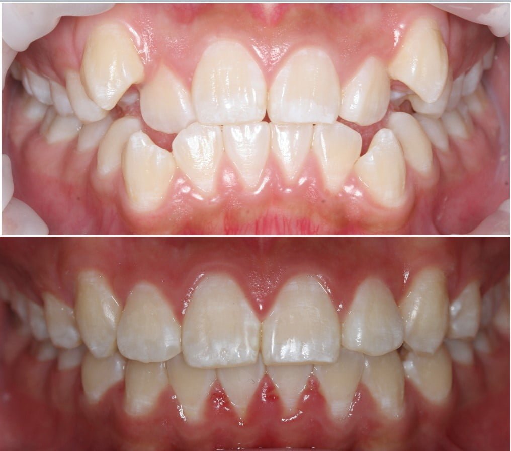 Surrey Hills dentures