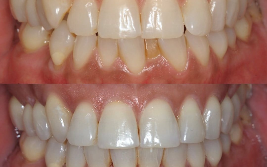Yellow No More: Achieving Whiter Teeth
