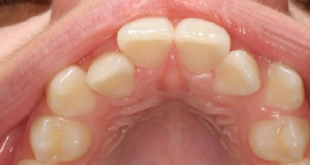 Crooked Teeth