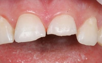 Chipped Tooth Repair in Melbourne: Your Options Explained
