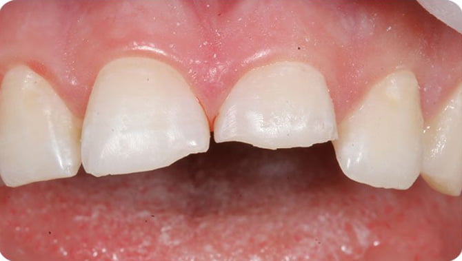 Chipped Tooth Repair in Melbourne: Your Options Explained