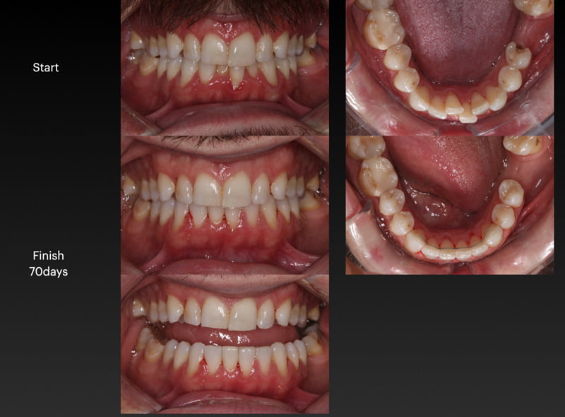 Crooked Teeth Transformation | Smile To Go