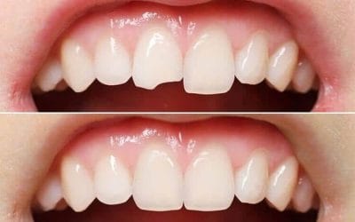 The Benefits of Resin Bonding: Why It’s a Top Choice for Smile Enhancements