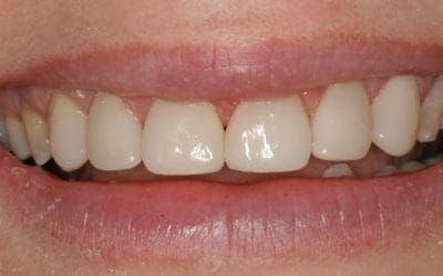 Can Resin Bonding Help with Misaligned Teeth? Exploring the Options