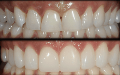 Composite Resin Bonding vs. Veneers: Which Smile Transformation is Right for You?