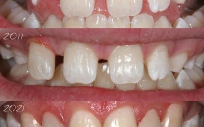 Does Resin Bonding Hurt? A Guide to Comfortable Smile Enhancements