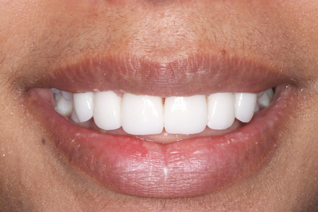 Porcelain Veneers | Smile To Go