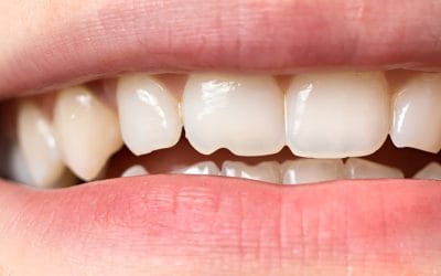 Chipped Tooth? Resin Bonding: Your Quick Fix for a Confident Smile