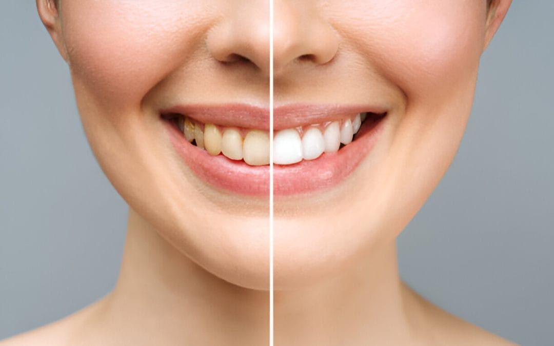 Yellow Teeth Got You Down? Explore Teeth Whitening and Resin Bonding Options