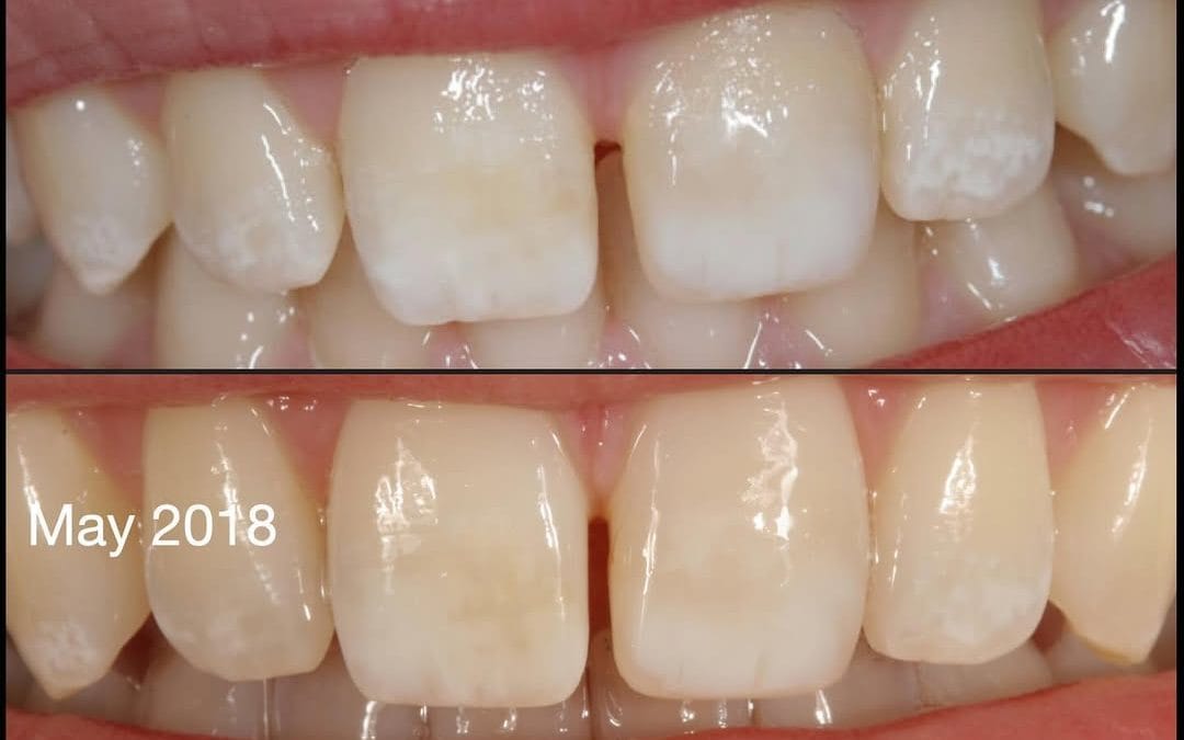 Bonding Before Veneers: Why You Don’t Need to Rush Into Porcelain
