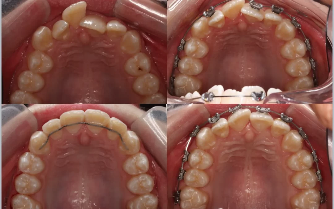 Fastbraces vs Traditional Braces: Not Just Quicker but Smarter